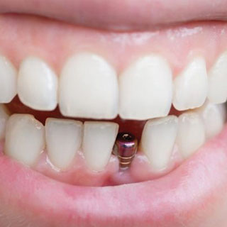 Implant dentaire
