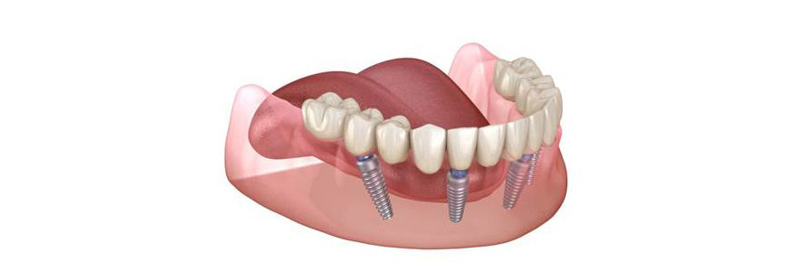 prothèse dentaire all on 4