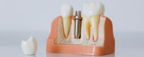 implant et facette dentaire