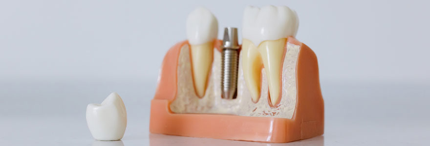 implant et facette dentaire